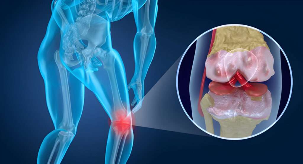 Knee Arthritis and How to Reduce Its Risk