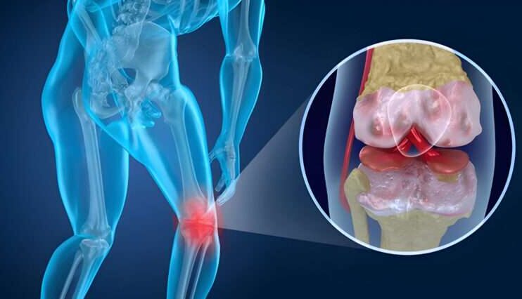 Knee Arthritis and How to Reduce Its Risk