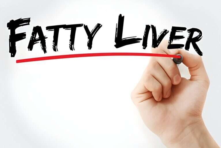 How Fatty Liver Disease Impacts Life Expectancy